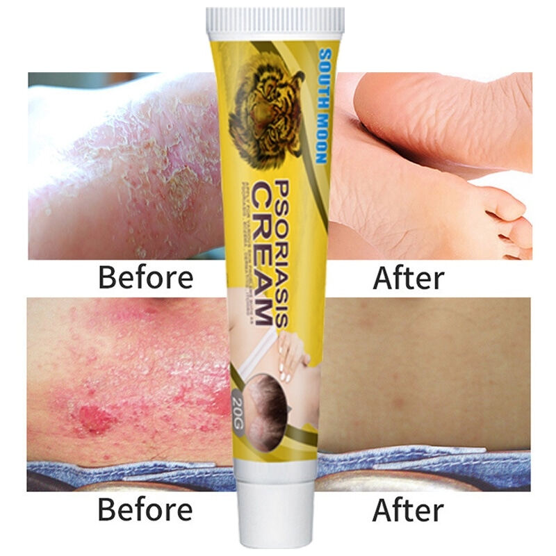 Eczema Cream Psoriasis Treatment Cream Ubat Gatal Gatal Kulit Quickly