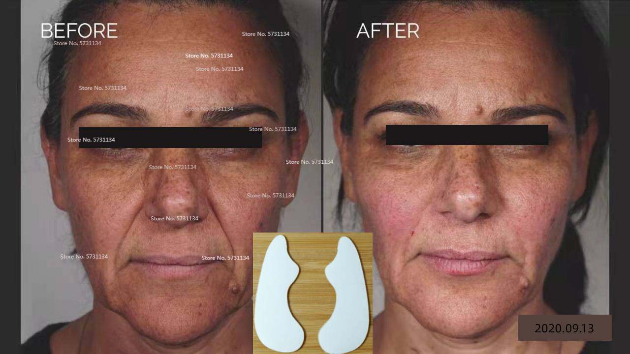 Instant Nasolabial Folds Patch Deep Wrinkle Line Smile Lines Treatment