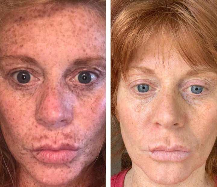 hydroquinone for melasma