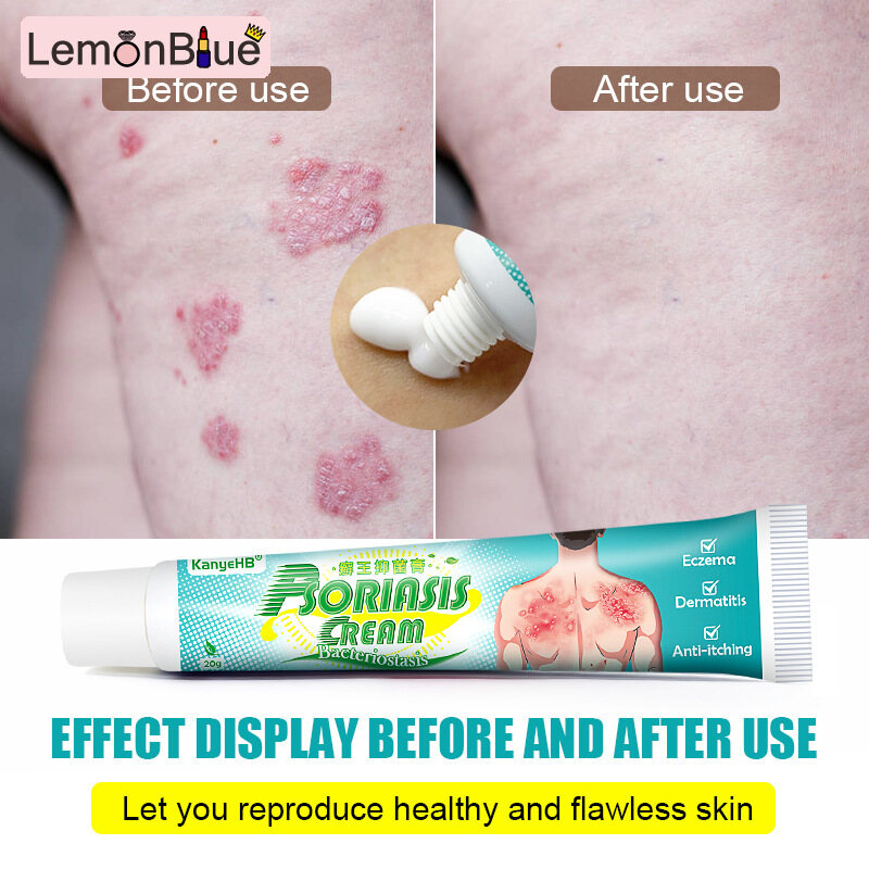 Psoriasis Itch Relief Cream Ointment Fungus Targeted Treatment Essence