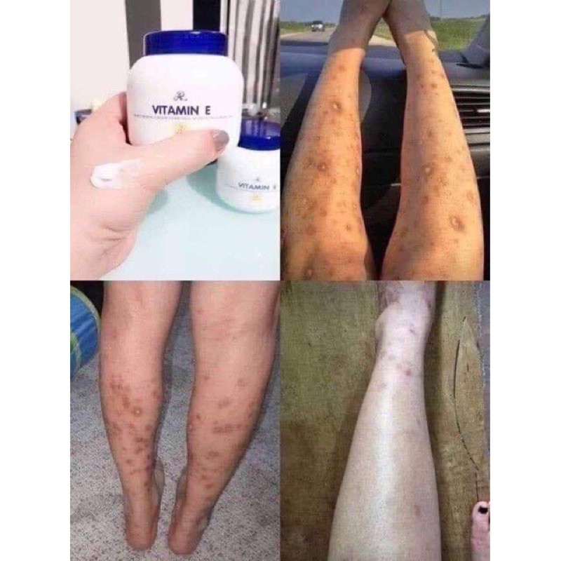 Original Vitamin E Hilang Cacar Parut Sunburn Lazada