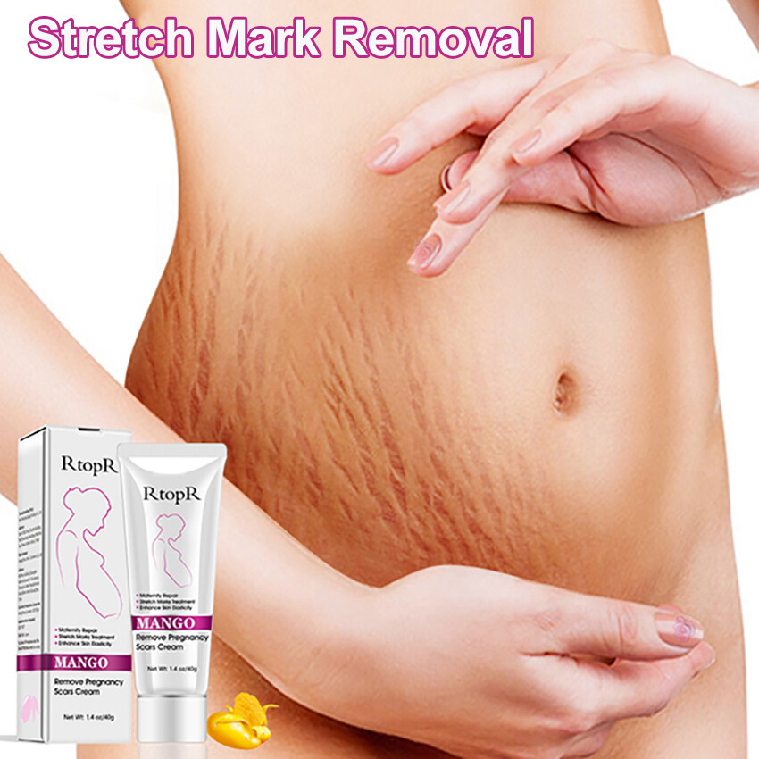 100% Original RtopR 40ml Mango Stretch Marks Remover Cream Eliminate Pregnancy Scars Maternity Repair Anti Winkle Skin Firming [Ready Stock]