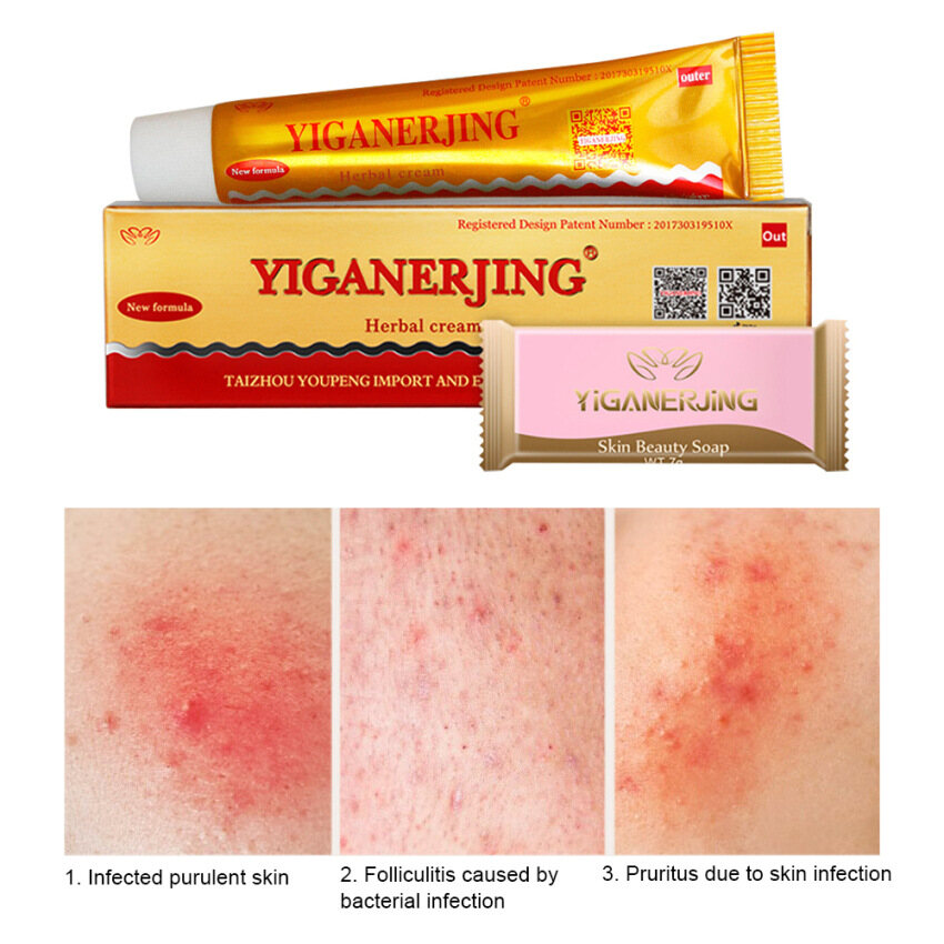 YIGANERJING (with retail box) Skin Psoriasis Cream Dermatitis Eczematoid Eczema Ointment