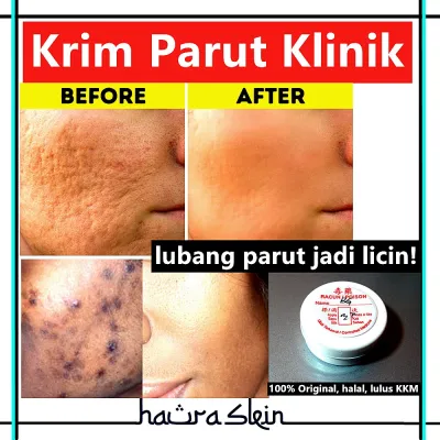 Scar Krim Parut Klinik Jerawat Scar Mask Skincare Klinik Kulit Jeragat Parut hitam Acne Spot Acne Pudar Fade