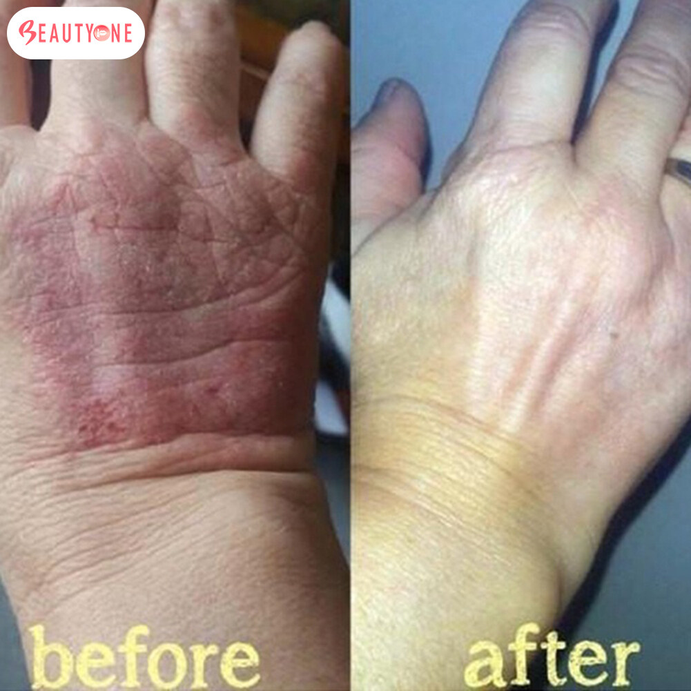 【COD】 Mupirocin Ointment Fungisol Anti Fungal Cream Dermovate Ointment