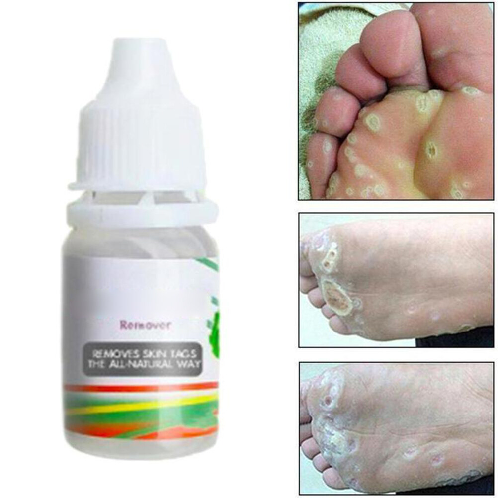 10ml-body-warts-mole-removal-liquid-skin-tag-remover-foot-warts-remover