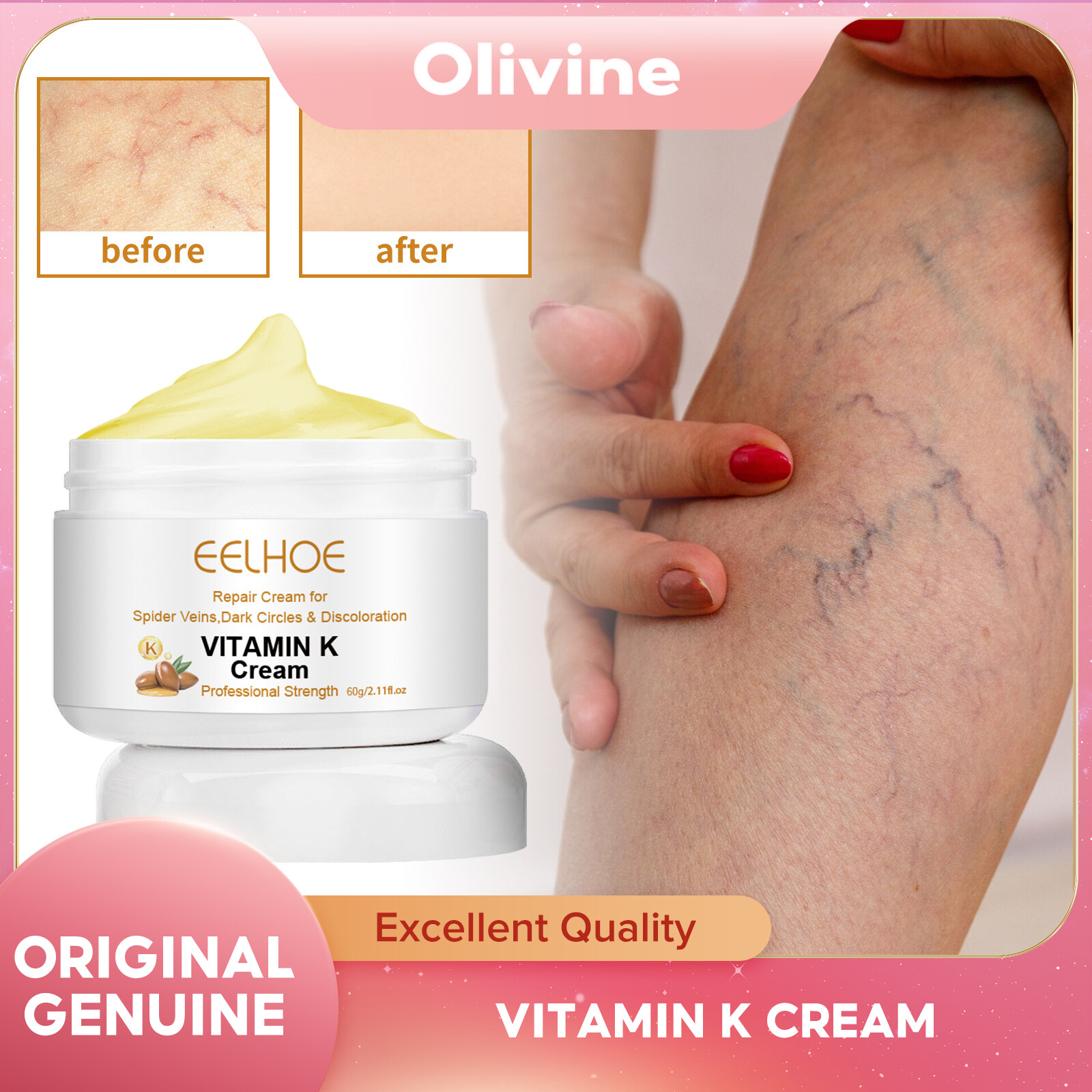 EELHOE Varicose Vein Treatment Cream Relieve Leg Spider Pain Vasculitis