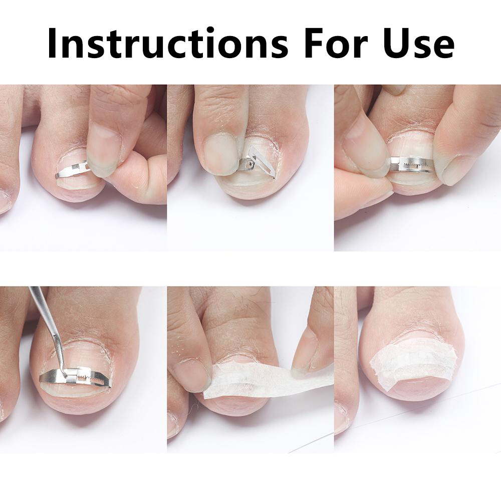 Ingrown Toe Nail Correction Tool Toenail Straightening Correctors Patch Tool