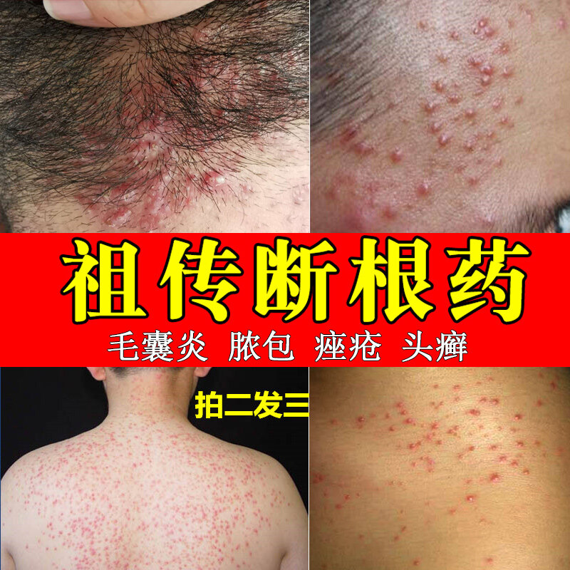 Treatment of folliculitis, head, chest, back, hands and feet, acne, acne, seborrheic dermatitis, skin itching, acne removal ointment