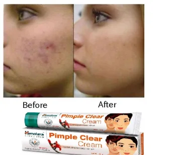 harga himalaya herbals acne pimple