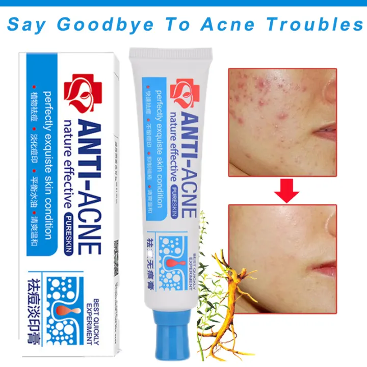 anti acne medicated cream