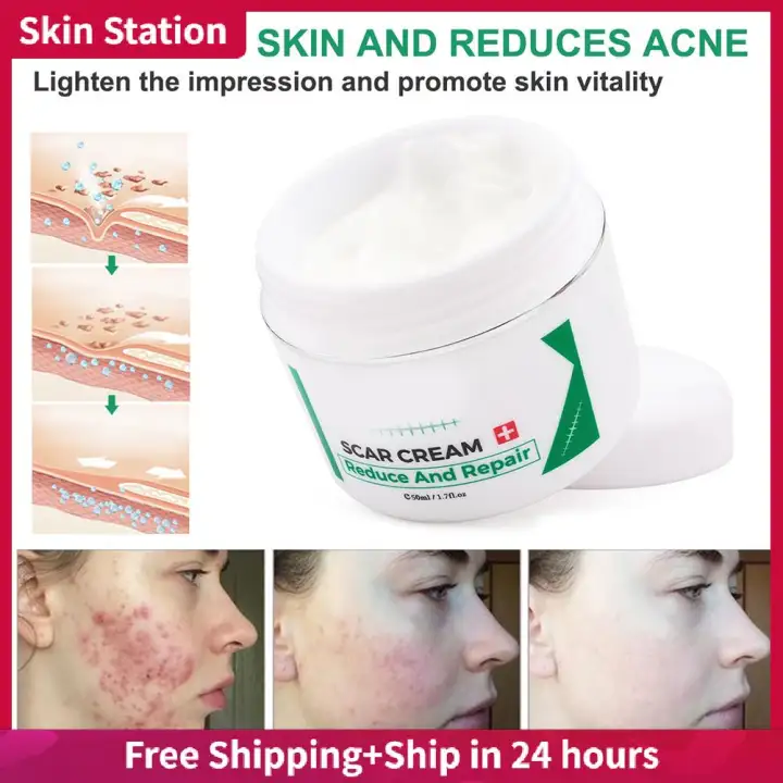 stretch mark lightening cream