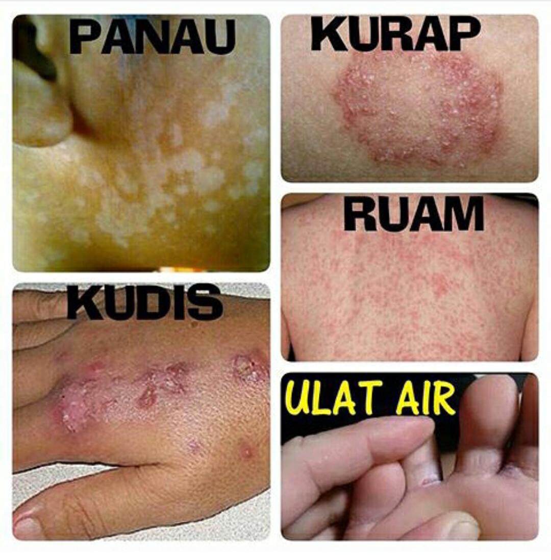 Ubat Panau Kudis Kurap Untuk Kanak Kanak Tidak Panas Lazada