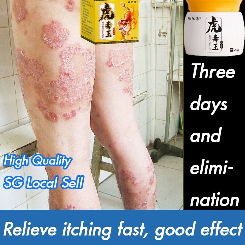 Ointment Natural Herbal Cream Body Psoriasis Eczema Dermatitis Pruritus