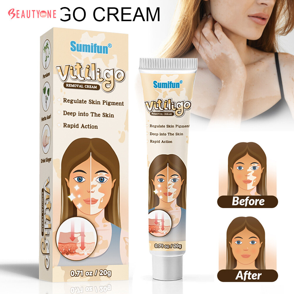 BeautyOne Vitiligo Removal Cream vitiligo skin treatment Vitiligo