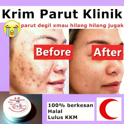 Krim Parut Klinik Pakar Kulit Berkesan Parut hitam Parut (PIH) Acne Spot Cream Jerawat Scar Acne Pudar berlubang