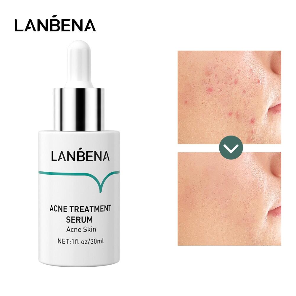 LANBENA Serum trị thâm mụn dưỡng ẩm mỹ phẩm chăm sóc da 30ML Serum Acne Treatment Moisturizing Facial Essence Skincare 30ML
