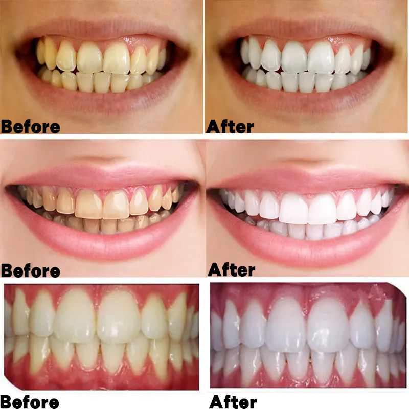 Kem đánh răng hunmui Dentist's Choice Probiotic (100g, xanh phiên bản màu trắng)