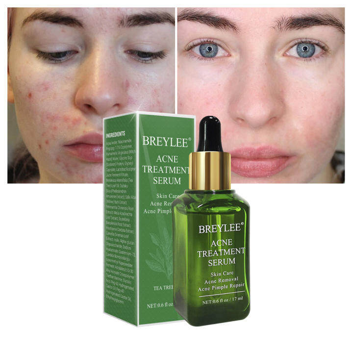 acne pimple serum