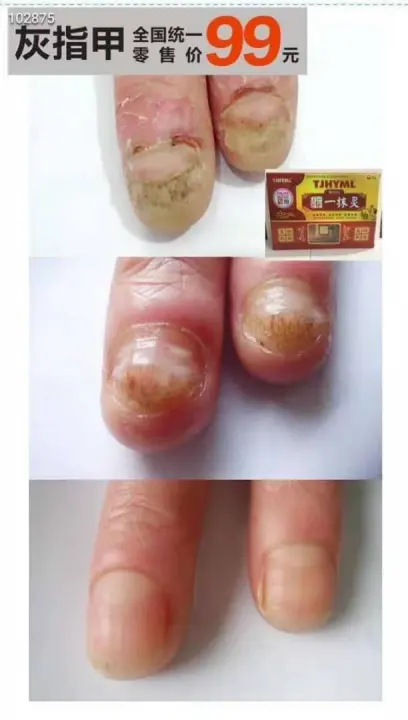 灰指甲克星鸡爪风 甲癣 油灰指甲 甲真菌病remedy For Onychomycosis Ringworm Of The Nails Nail Fungus Lazada 灰指甲克星鸡爪风 甲癣 油灰指甲 甲真菌病remedy For Onychomycosis Ringworm Of The Nails Nail Fungus Lazada