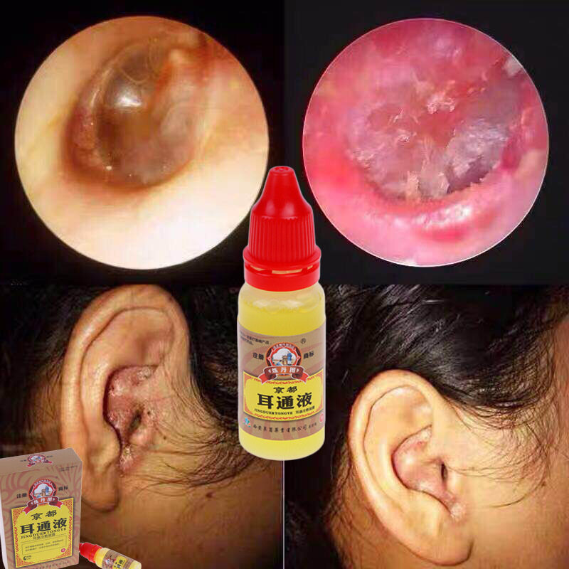 100-original-cod-2022-new-15ml-bottle-ear-liquid-acute-otitis-drops