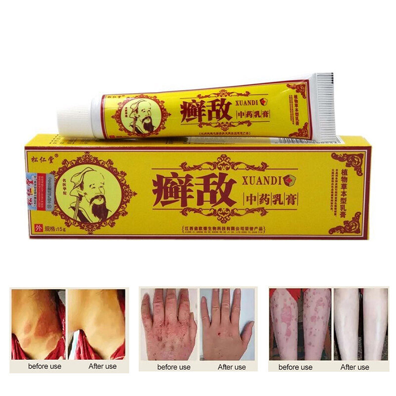 Psoriasis Eczema Cream Antifungal Antibacterial Itchy Cream Eczema Ringworm Ubat Gatal Kurap Krim For Skin Problems Skin Care 15g Ready Stock Lazada