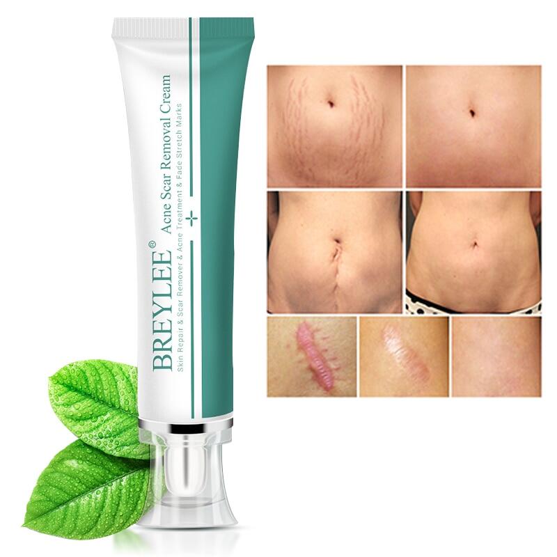 breylee scar removal cream