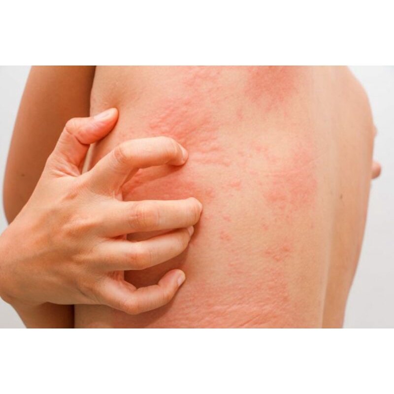 Shop Ubat Badan Gatal Online Jun 2022 Lazada Com My