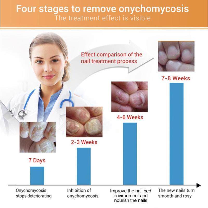 Bảng giá 12 ML Tự Nhiên Mạnh Mẽ Móng Tay Sửa Chữa Tinh Chất Chống nấm Móng Điều Trị Hiệu Quả Sửa Chữa Giải Pháp Điện máy Pico