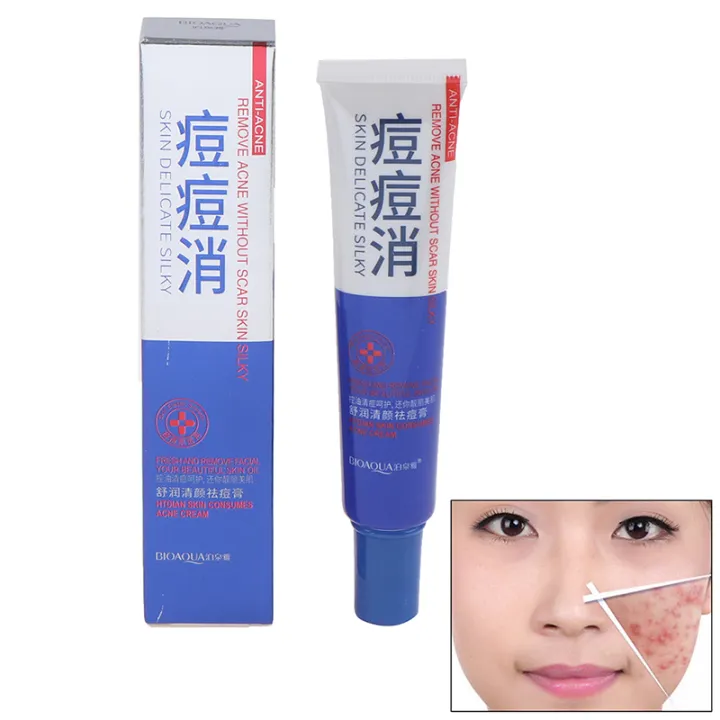 pimple and blackhead remover cream