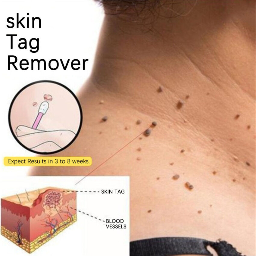 warts and papillomas treatment)