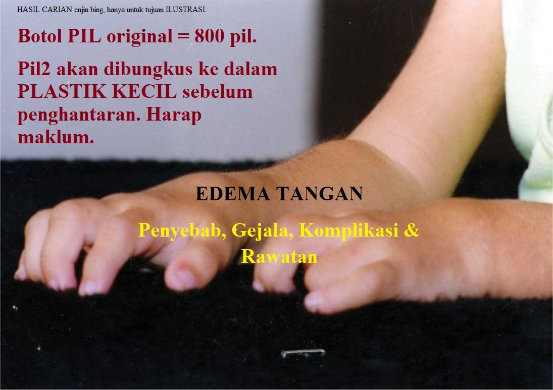 Tanda Tangan Bengkak 手水肿 Edema Hand Bentuk Pil⭐lainindividulainkesan Ubat Tradisional Lazada