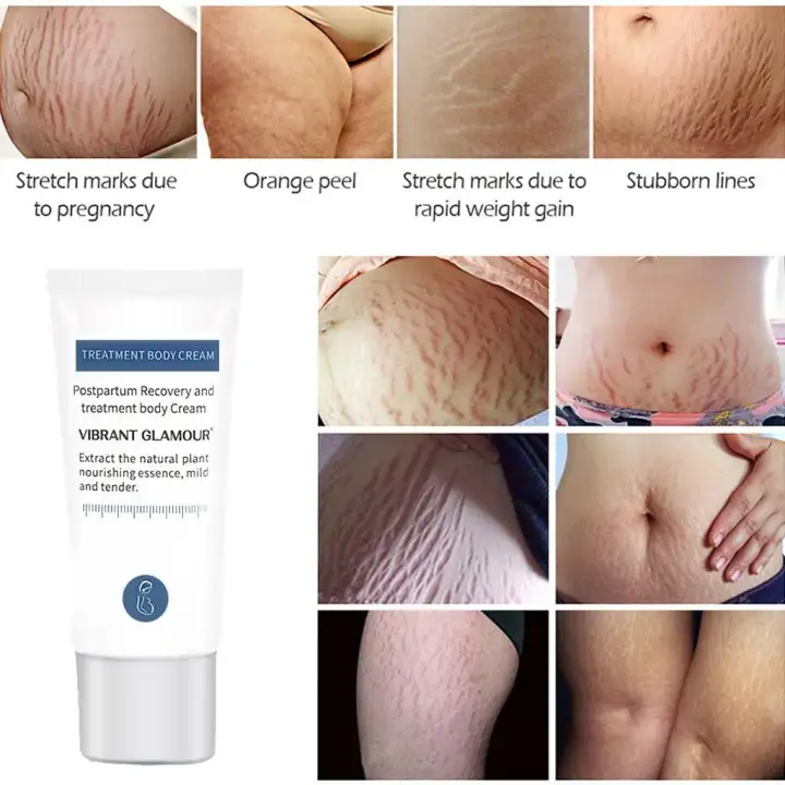 cream for striae gravidarum
