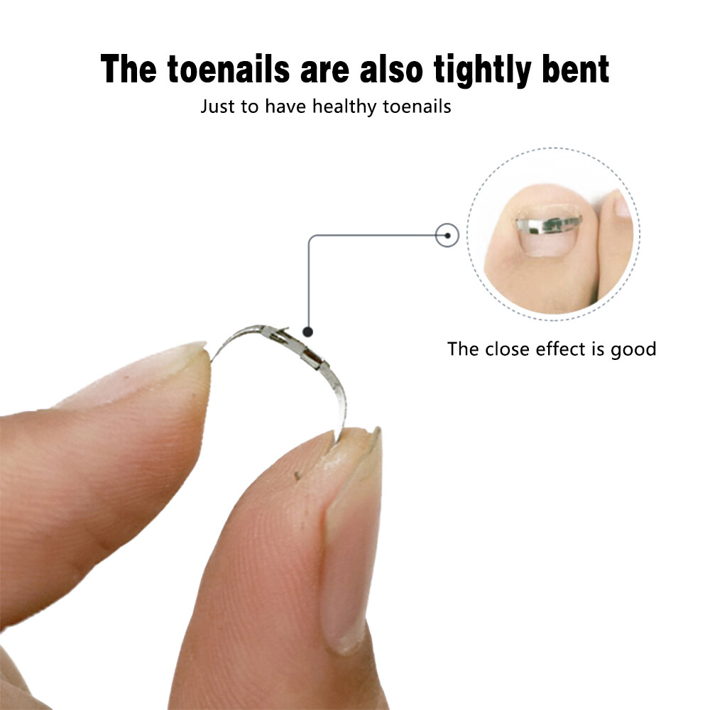Ingrown Toe Nail Correction Tool Toenail Straightening Correctors Patch Tool