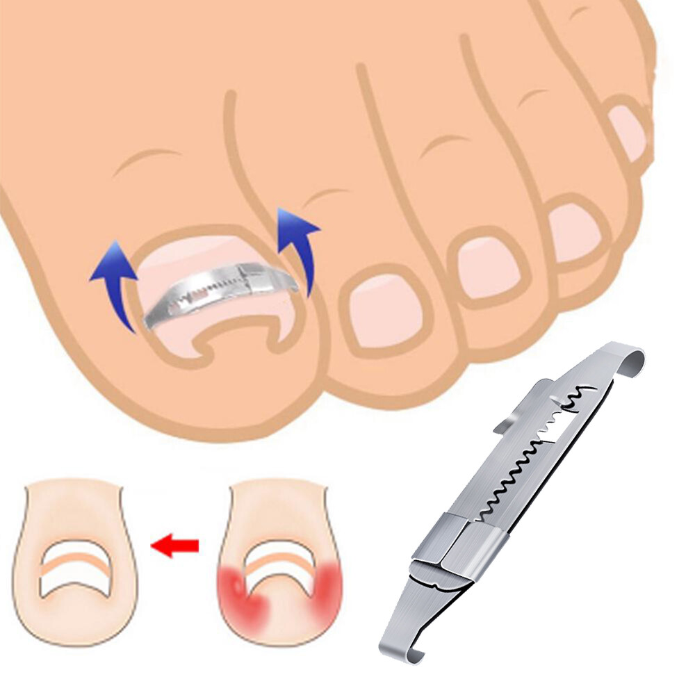 Ingrown Toe Nail Correction Tool Toenail Straightening Correctors Patch Tool