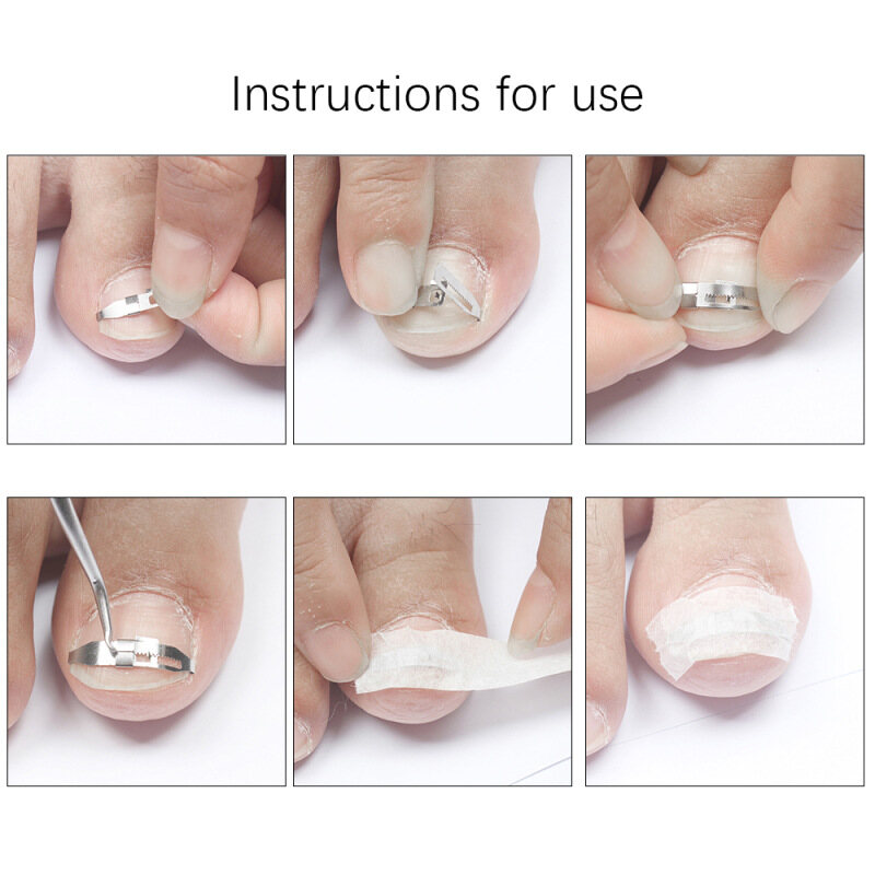 【 100% gốc + COD】Ingrown Chân Móng Tay Công Cụ Chỉnh Sửa Móng Chân Thẳng Hiệu Chuẩn Vá Bộ Công Cụ