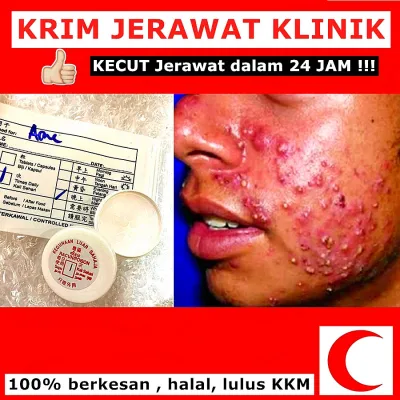 (9.9) Krim Jerawat Klinik Kulit 100% KECUT BERKESAN Acne Cream Pimples Acne Skin Jerawat 5g 10g 100% Original Acne Prone
