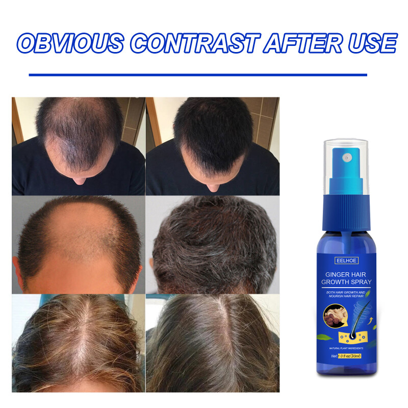 AOLIAO EELHOE Ginger Hair Growth spray Hair Growth Serum Ginger Hair Treatment Essence Anti Hair Loss Spray Essential Minoxidil Fast Grower Hair Grower Castor Oil Hair Growth Spray anti Hair Loss Serum Minoxidil Preventing Baldness Consolidate Hair