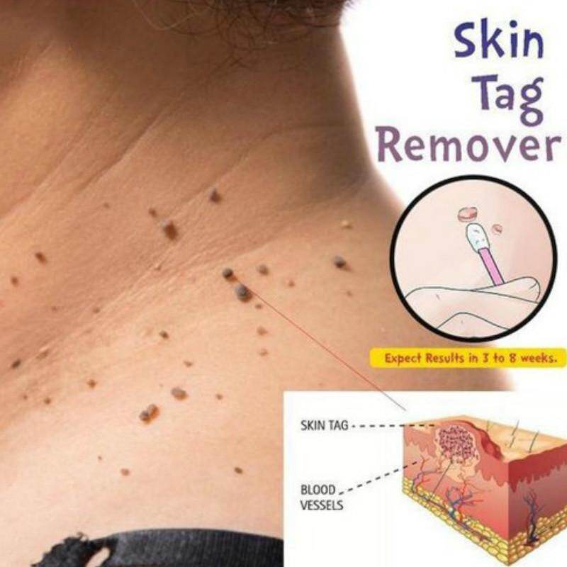 skin tag removal cost