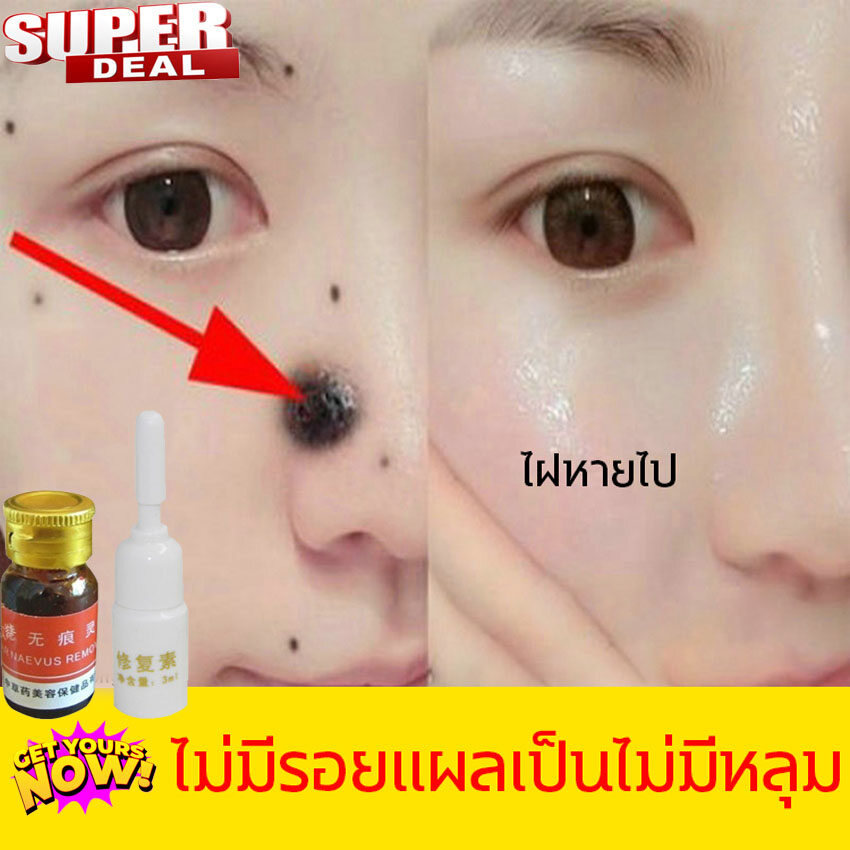 Mole & Skin Tag Removal Solution Painless Mole Skin Dark Spot Removal Face Wart Tag Freckle Removal Cream Oil Plaster