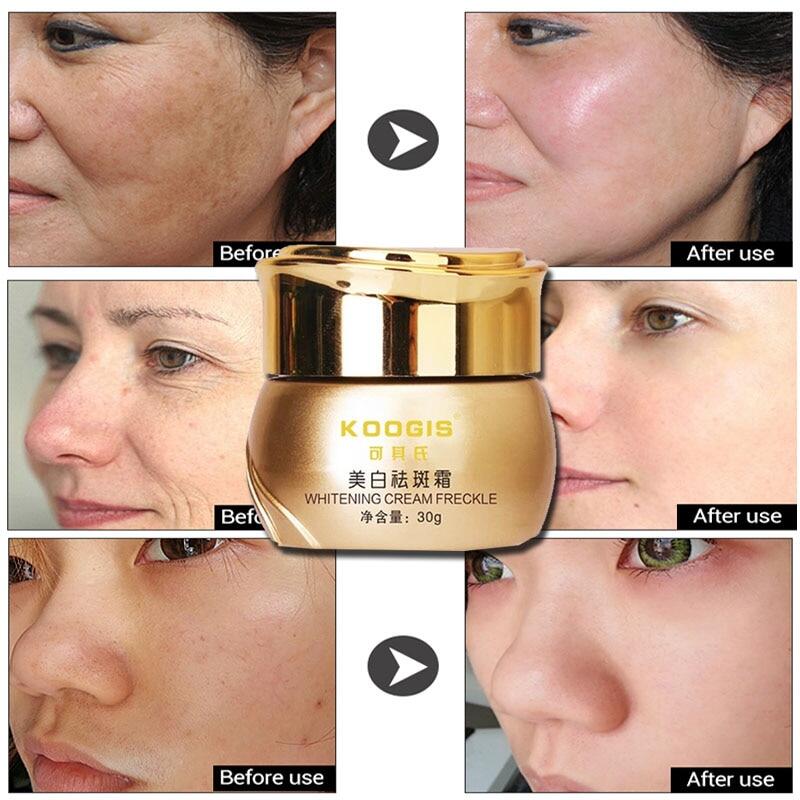 pigmentation cream for face
