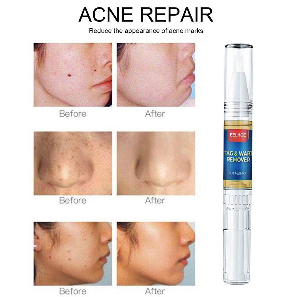 Gambar ?2pcs?HOLD LIVE Skin Tags Remover Mole Removal Pen Portable Safety Mole Removal Machine Dark Spot Eraser Face Care