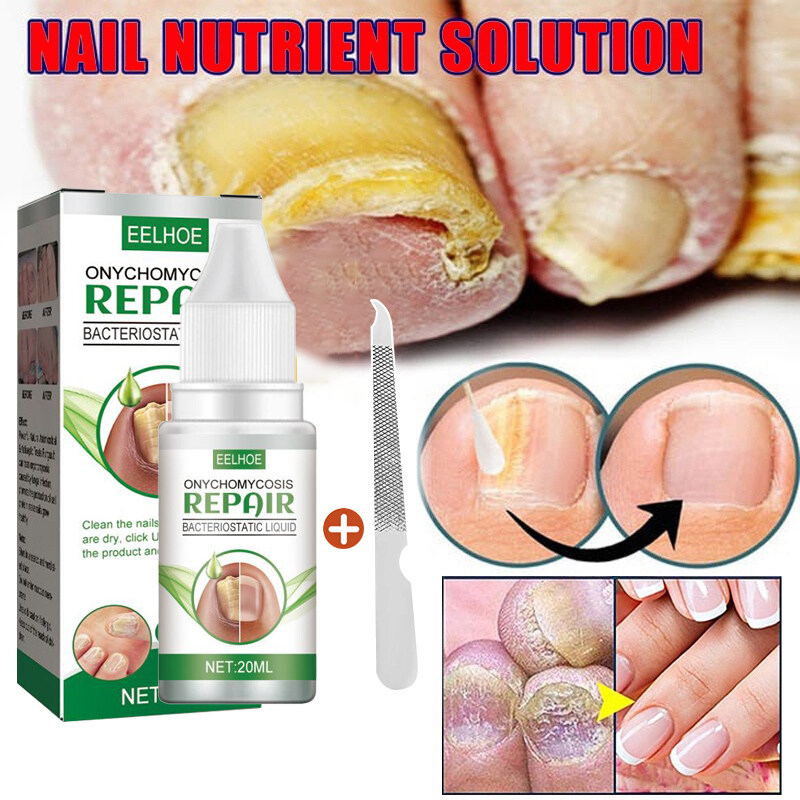 eelhoe Nail fungus treatment fungus nail treatment nail repair liquid ...