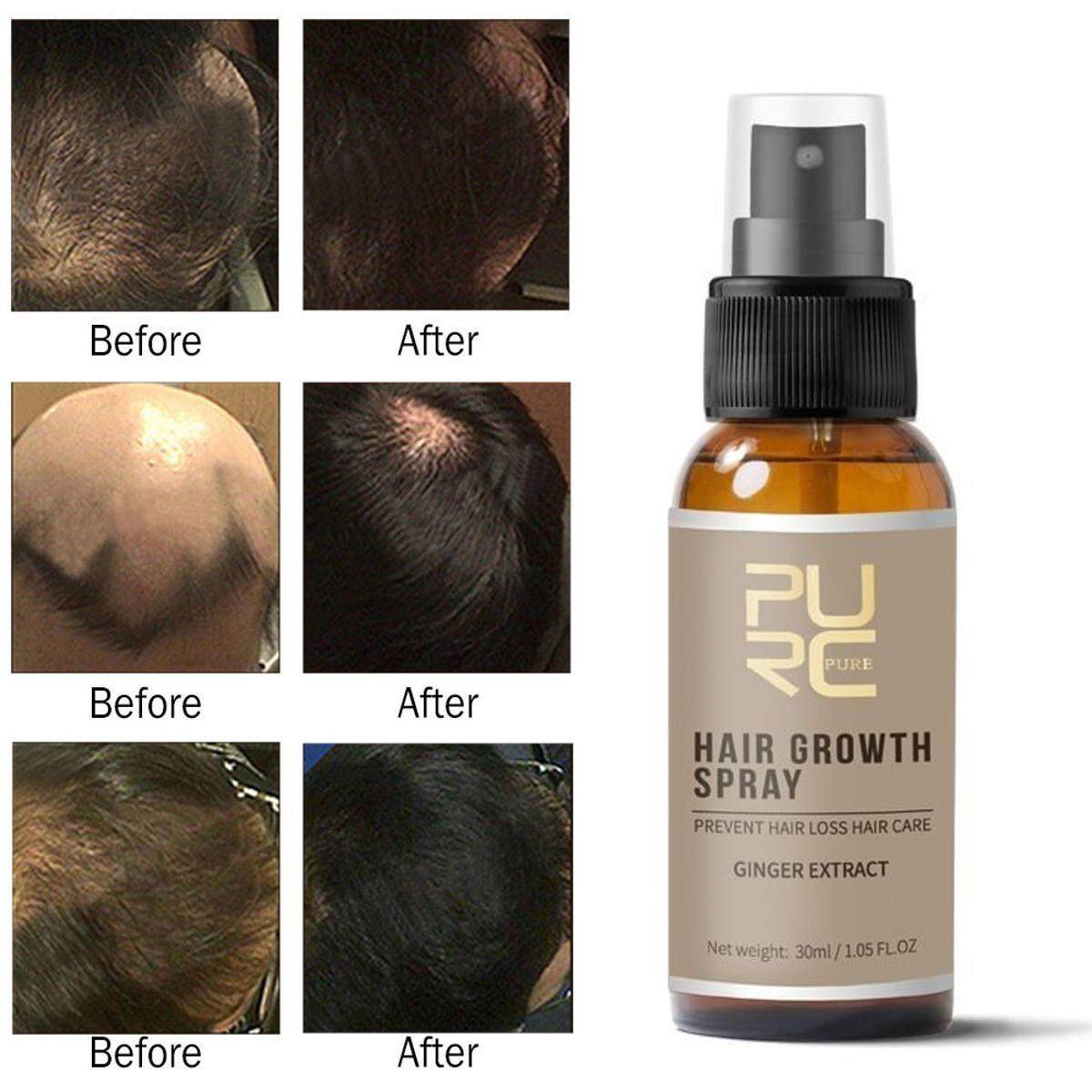 Purc 30ml Anti Hair Loss Hair Liquid Essence Spray Female Male Prevent