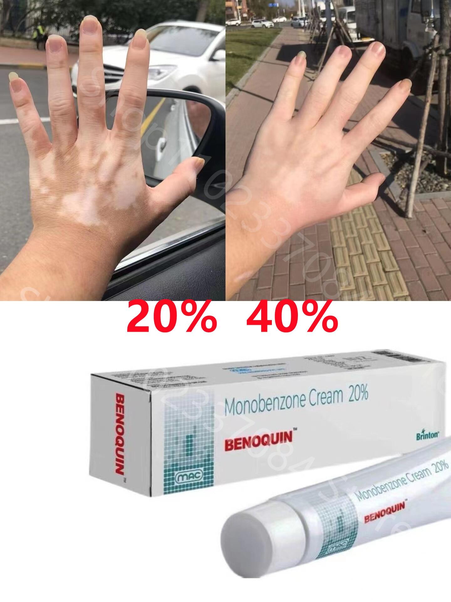 Origin Monobenzone Whiten Cream Vitiligo Skin Bleaching Creame Remove