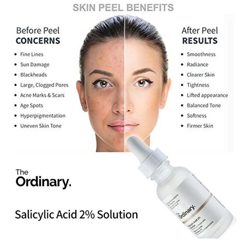 the ordinary solution for acne