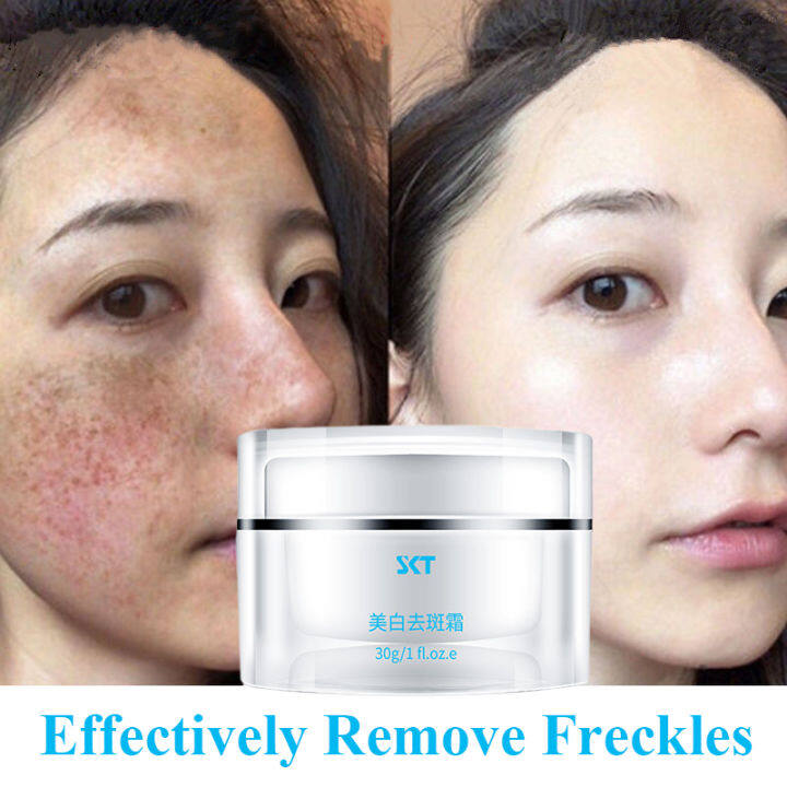 Whitening Freckle Cream Remove Melasma Cream Krim jeragat Remove Melasma Cream Remove Dark Spots Melanin Melasma Brighten Skin Anti-Ag 美白祛斑霜
