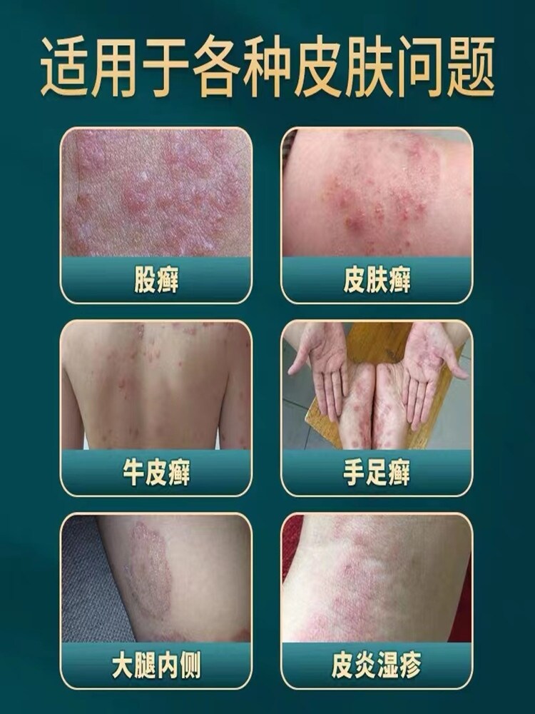 Eczema root removal external use stubborn dermatitis inner thigh