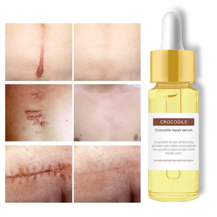 serum acne whitening