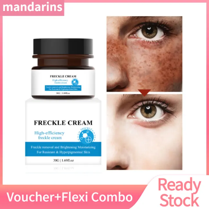freckles treatment cream